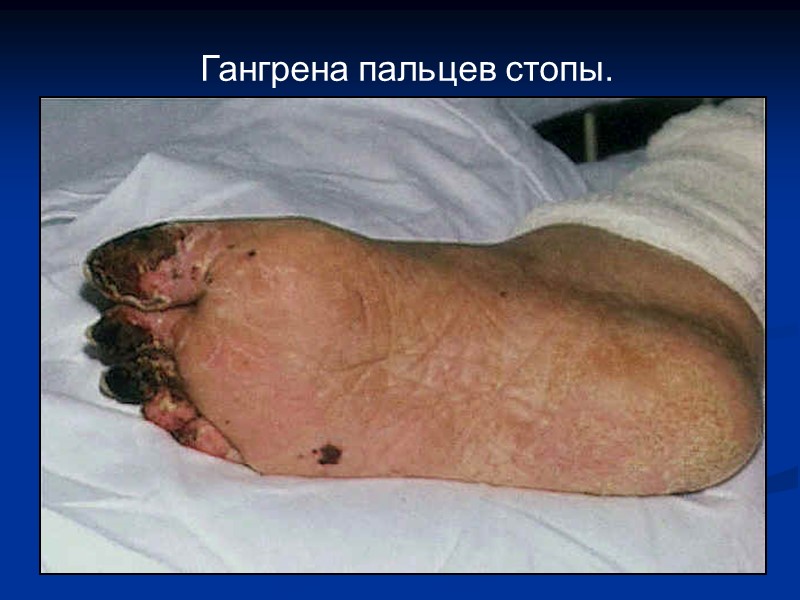 Гангрена пальцев стопы.